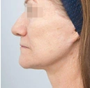 Face surgery procedures at The Layt Clinic, sample 1, after